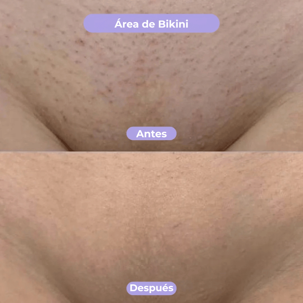 Luneva ByeVello™